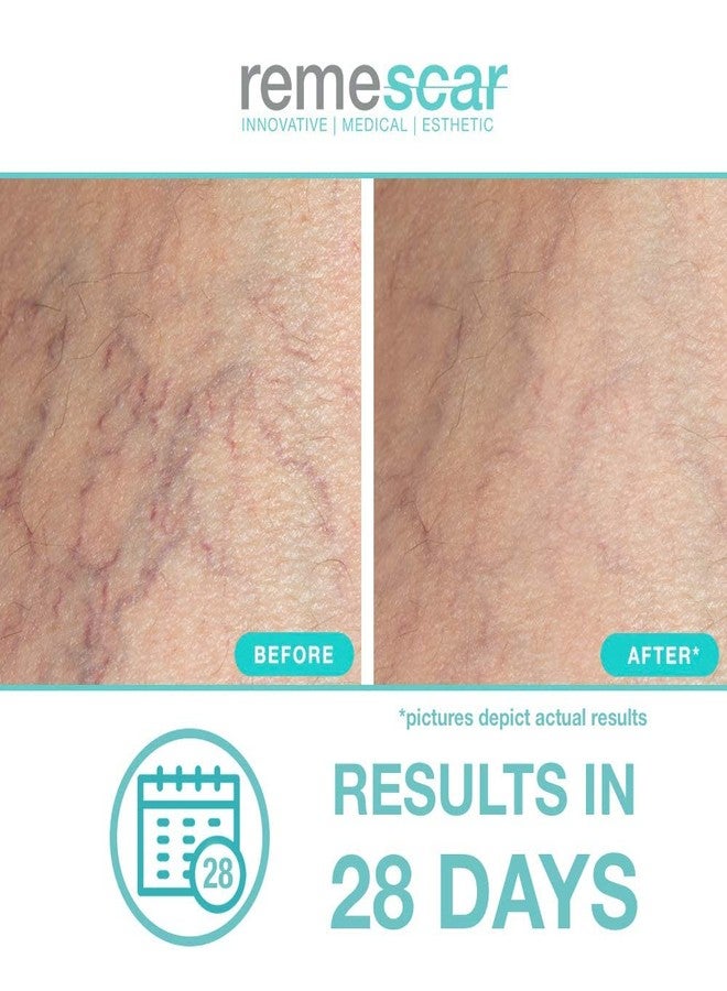 Remescar - Spider Veins Treatment - Spider Vein Cream for Legs, Abdomen & Face - Thread Vein Prevention Cream for Men & Women - Spider Vein Reduction Treatment - Instant Results - Image 3